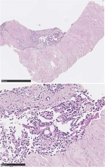 Biopsy Specimens Stained With Hematoxylin And Eosin Stain Biopsy