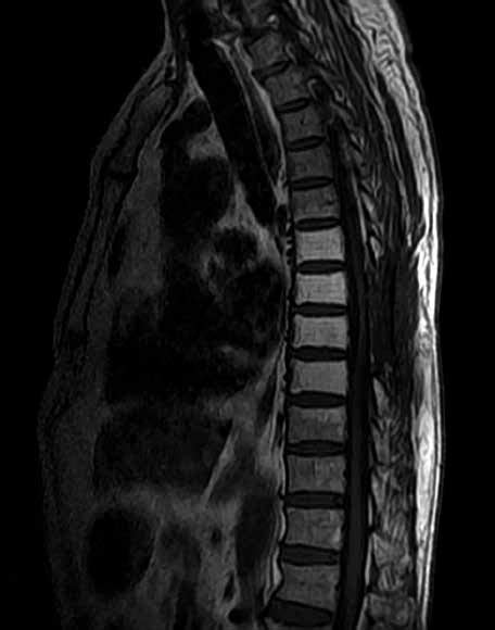 Sagittal T1 Weighted A And T1 Contrast Enhanced B Images Showing No