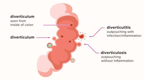 Diverticulitis Inflamed Bowel Diverticula Vitalis Health Colon