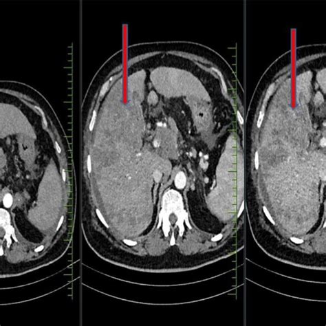 Triple Phase Liver Imaging Axial Ct Shows Ill Defined Heterogeneously Download Scientific