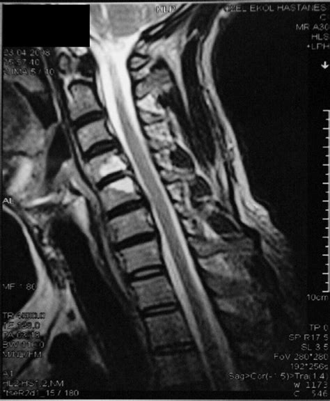 A Patient With Brucellar Cervical Spondylodiscitis Complicated By