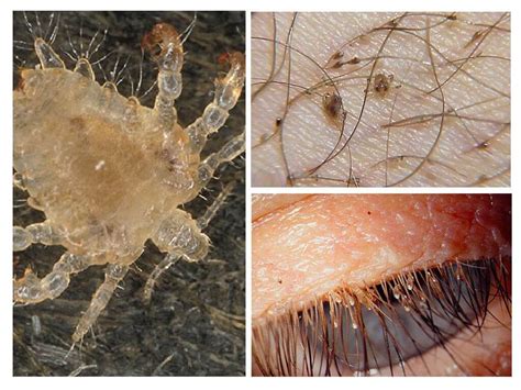 Pubic Lice Symptoms And Treatment How To Get Rid At Home