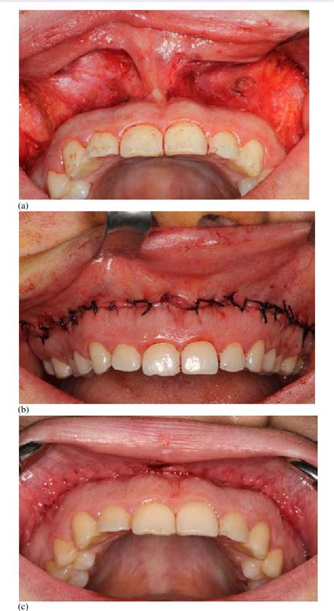 Figure 1 From Treatment Of Excessive Gingival Display Using A Lip