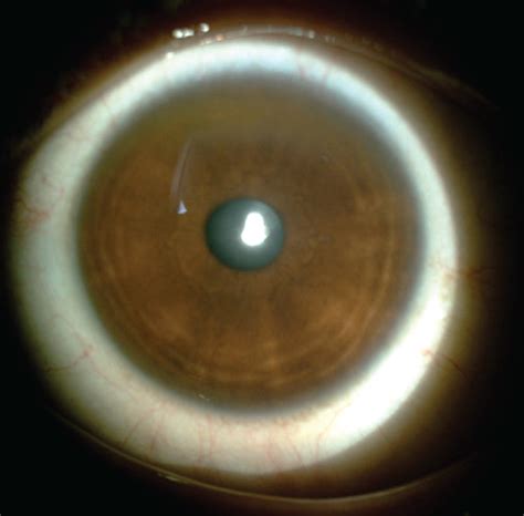 Slit Lamp Photograph Of The Right Eye A And The Left Eye B