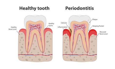 What S A Periodontist How They Differ From Dentists