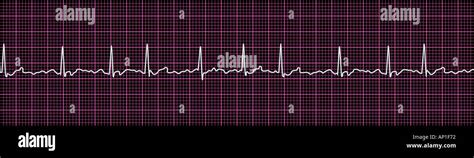 Vorhofflimmern Ekg Hi Res Stock Photography And Images Alamy