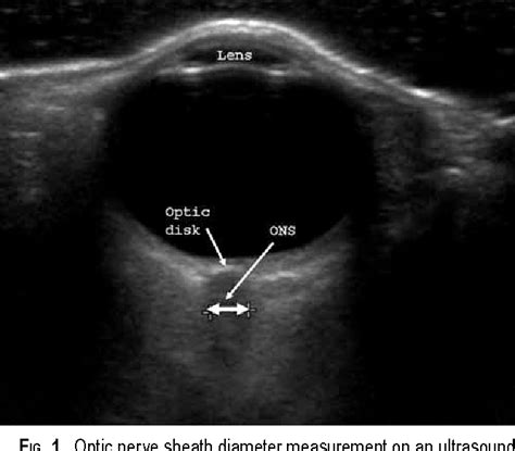 Optic Nerve Sheath Diameter