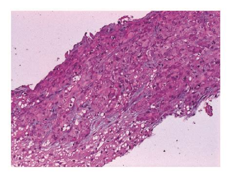 A Liver Biopsy Showed Tumor Tissue Diffusely Infiltrating The Liver