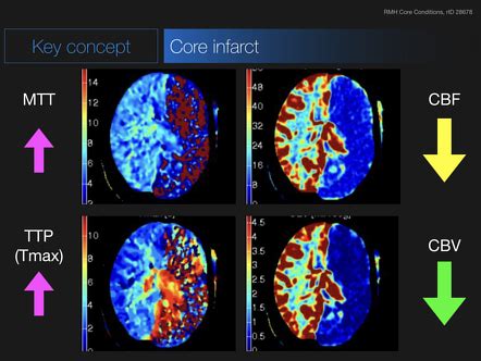 Role Of CT Perfusion In Acute Stroke Management, 47% OFF