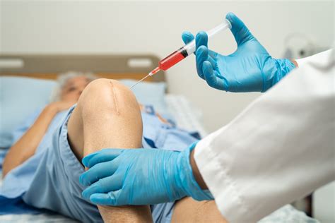 Platelet Rich Plasma Prp Injection For Knee Osteoarthritis Oa And