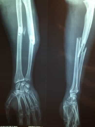 Leg Compound Fracture X Ray - Foto Kolekcija