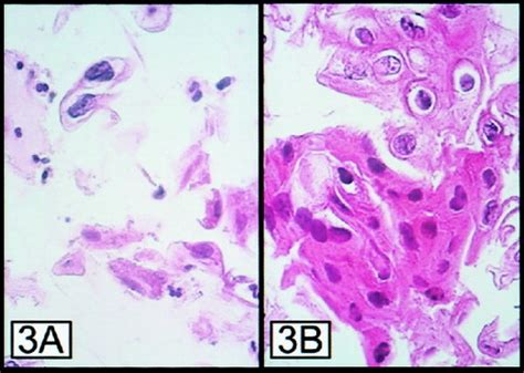 Diagnostic Value Feasibility And Validity Of Preparing Cell Blocks