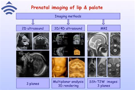 Figure 1 From Prenatal Imaging Of Facial Clefts By Two Dimensional And