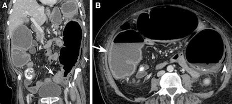 Perforated Sigmoid Colon Secondary To An Obstructing Colon Cancer A Download Scientific