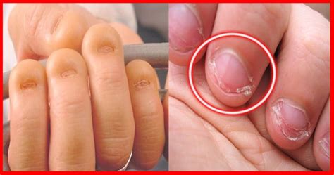 Dicas Para Parar De Roer As Unhas Para Sempre Dicas De Sa De