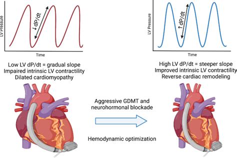 Left Ventricular Hemodynamics Can A Direct Assessment Of Left