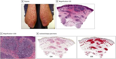 Numerous Pink Purple Papules In A Middle Aged Man Dermatology Jama