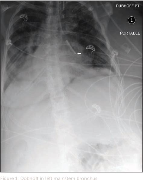 Figure 1 From Technique For Safe Placement Of A Dobhoff Tube Without A