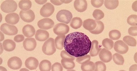 Fichero De Hematologia Promielocito