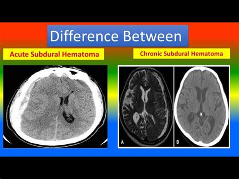 Chronic Subdural Hematoma Vs Acute