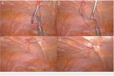 Figure 1 From Preventing An 8 Mm Port Site Hernia In Robot Assisted