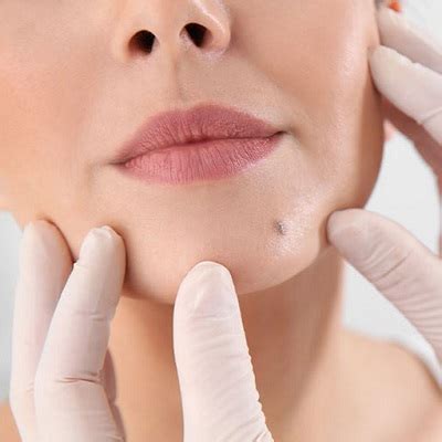 Mole Removal In Lahore Gujranwala Pakistan Glamorous Clinic