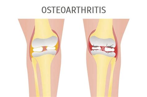 Frequently Asked Questions about Arthrosis - Health & Detox & Vitamins