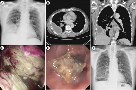 Empyema Thoracis Complicated By Anaemia As Caused By Occult Bonelet