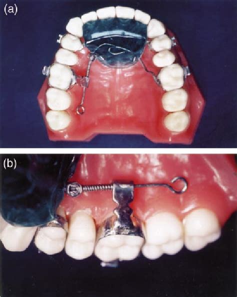 Figure From Maxillary Unilateral Molar Distalization With Sliding