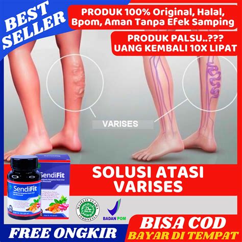 Obat Untuk Pengobatan Varises Herbal Nyeri Pada Betis Sakit Telapak