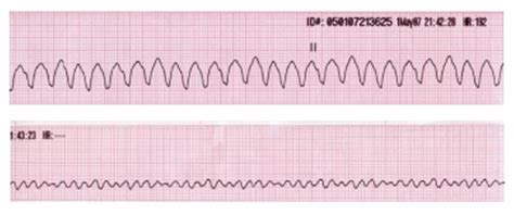 ACLS Flashcards Quizlet