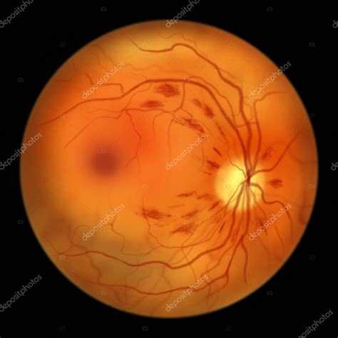 Retinopatía Diabética No Proliferativa Ilustración Que Muestra