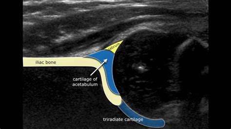 Developmental Dysplasia Of The Hip Ultrasound