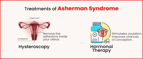 Asherman Syndrome Causes Symptoms And Treatment