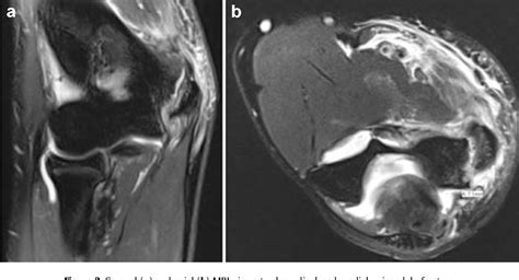 Figure 1 From Novel Fixation Of Medial Epicondyle Fractures In A