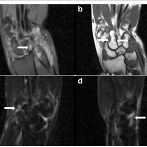 Typical Case 52 Year Old Female Diagnosed With Ra For 1 Year Mri