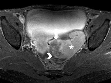 Magnetic Resonance Imaging In Tubal And Non Tubal Ectopic Pregnancy