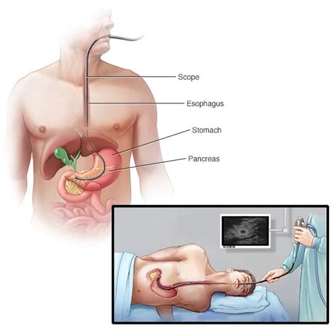 endoscopic ultrasound procedure  teynampet chennai dr aditya shah
