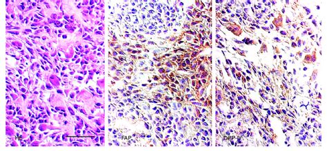 Immunohistochemistry of a fibroblastic area of an osteosarcoma ...