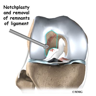 ACL Hamstring Tendon Graft Reconstruction | eOrthopod.com