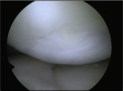 Autologous Chondrocyte Implantation Aci For Cartilage Defects Of The Knee A Guideline By The