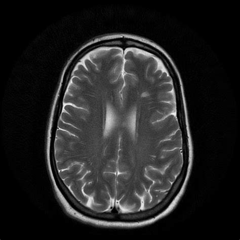 Radiology Cases: MS presenting with severe headache