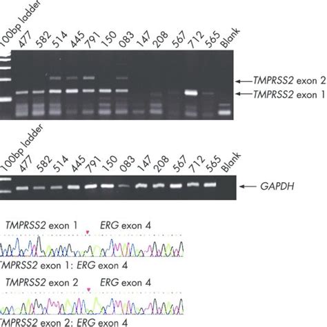 A Reverse Transcriptase RT PCR Analysis Of The TMPRSS2 ERG Fusion