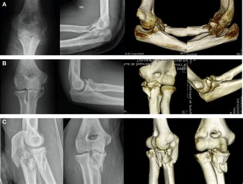 Complex Elbow Dislocations Patterns After Primary Or Spontaneous Download Scientific Diagram