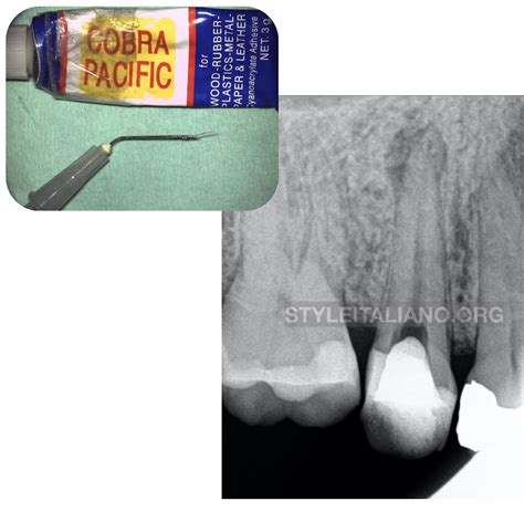 Alternative Method For Removing Fractured Instrument A Case Report Style Italiano Endodontics