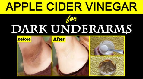 Apple Cider Vinegar For Dark Underarms