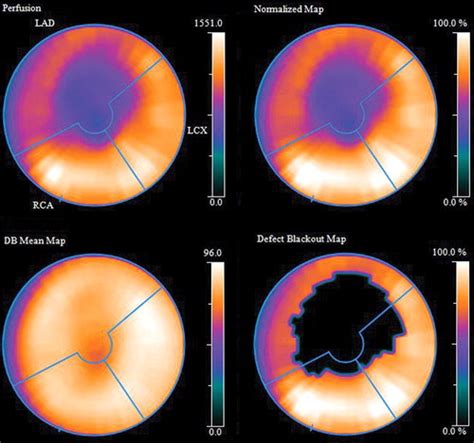 Interpretation Of Spectct Myocardial Perfusion Images Common