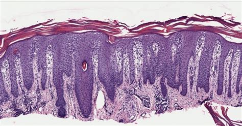 Differential Diagnosis In Dermatopathology Parakeratosis