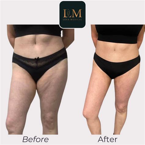 J Plasma Treatment The Next Level In Skin Tightening Therapy Leva