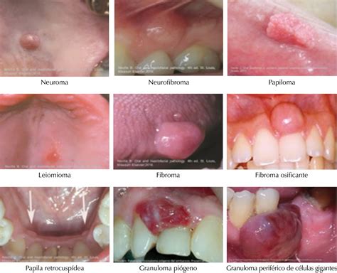 Removal Of Fibroma In The Mouth Or Lip Melbourne Dentist